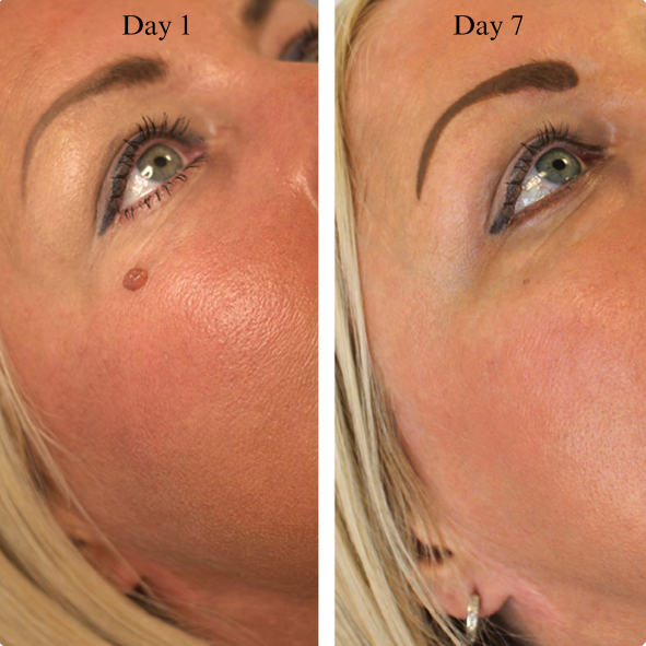 Tagbuddy™ kit (No more skin tags )