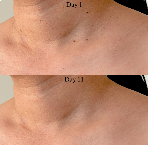 Tagbuddy™ kit (No more skin tags )