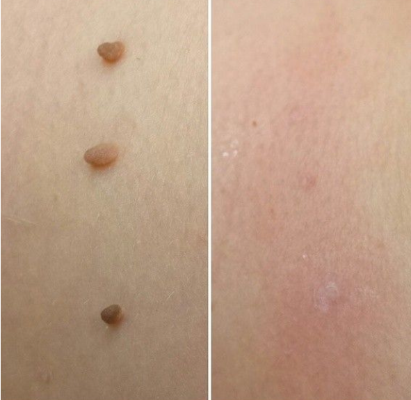 Tagbuddy™ kit (No more skin tags )