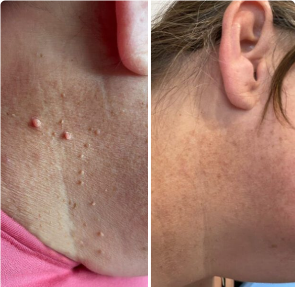 Tagbuddy™ kit (No more skin tags )