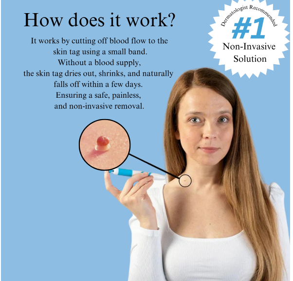 Tagbuddy™ kit (No more skin tags )