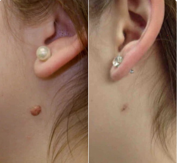 Tagbuddy™ kit (No more skin tags )